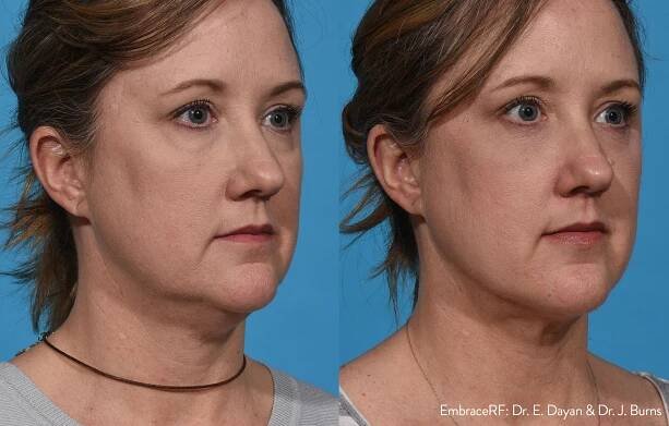 Morpheus8 Skin Tightening Treatment in Kearney, NE | U Med Spa