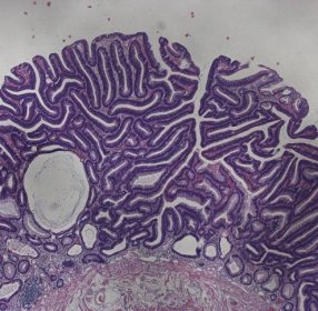 Dieser Blick auf die Schleimhaut im Dickdarm zeigt ein sogenanntes Tubulaeres Adenom, das sich durch ein verzweigtes Drüsensystem auszeichnet. Es kann gutartig sein – aber auch das Vorstadium eines sich entwickelnden Darmkrebs