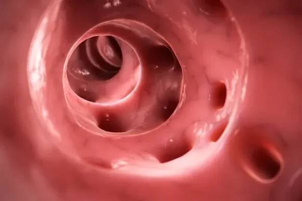 Cramps, fever, nausea and blood in stool may be due to diverticulosis. 