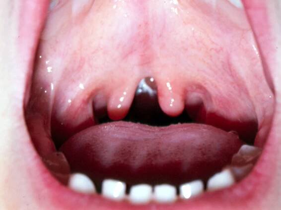 Submucous Cleft Palate | Hellenic Craniofacial Center