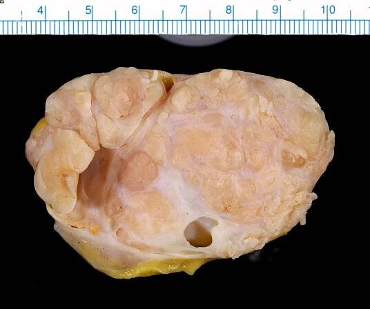 50 Facts About Phyllodes Tumor