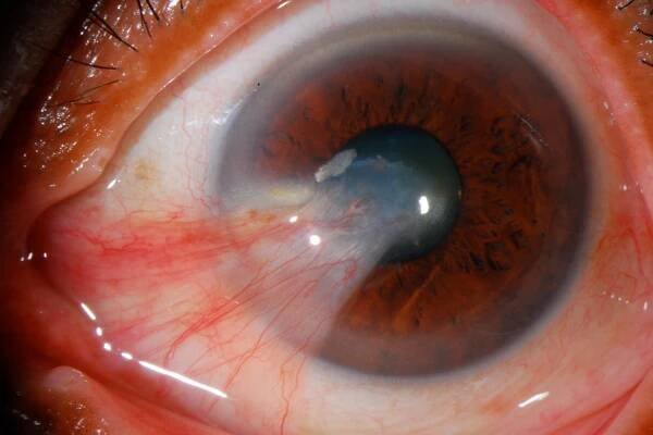 Pterygium conjunctivae