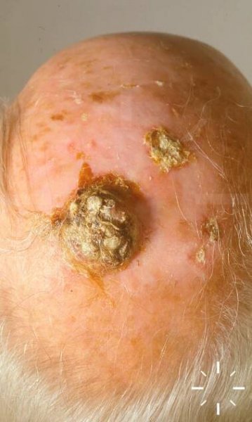 DermaCompass - Squamous cell carcinoma of the skin (spinocellular carcinoma, SCC) 