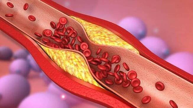 Cholesterol superfood unclogs arteries 'better than aspirin'