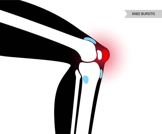 Ultrasound-Guided Anserine bursa