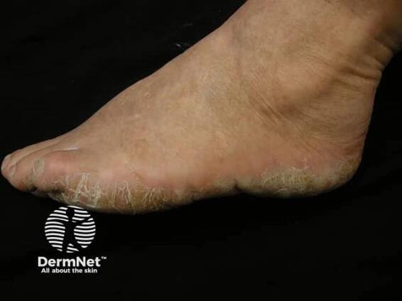 Palmoplantar psoriasis