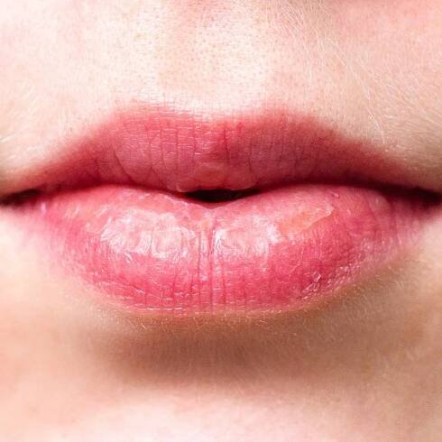 Natural Remedies for Chapped Lips