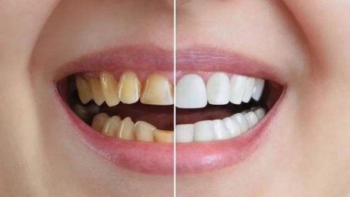 Domácí bělení zubů jenom za pár korun: Přísady má doma každý, výsledky se objeví už za týden