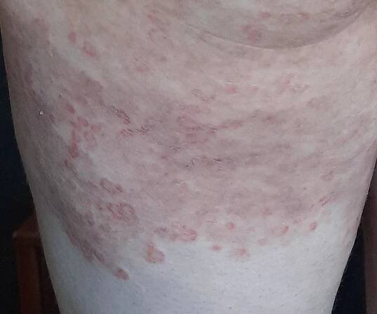 Skin mycoses (ICD10: B35-B49) - Online consultation AI dermatologist