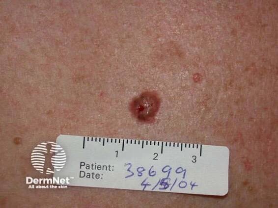 Basal cell carcinoma