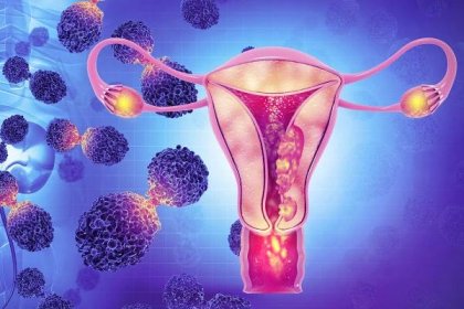 “Unprecedented” PFS Benefit With Selinexor in p53 Wild-Type Endometrial Cancer