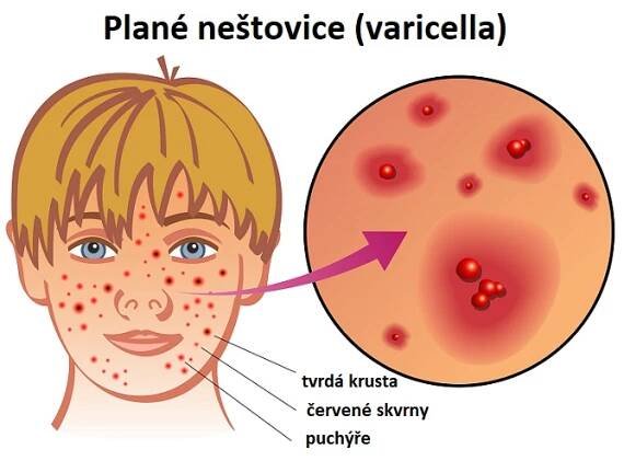 Toto onemocnění je charakteristické výsevem svědivých vyrážek a puchýřků po celém těle.