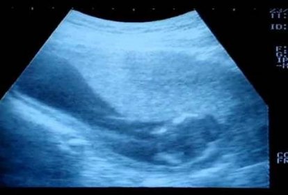 Ultrazvuk - 15. týden těhotenství