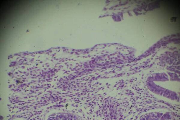 biopsie adenomyózy pod lehkou mikroskopií - myoma - stock snímky, obrázky a fotky