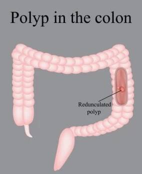 Polyp in the intestine. Polyp in the colon. Vector illustration on a gray background