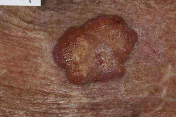 909 Archives - Skin Cancer 909