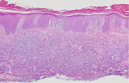 Mycosis Fungoides Plaque Stage