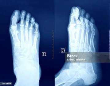 Stock fotografie Rentgenový Snímek Nohy – stáhnout obrázek nyní - Rentgenový snímek - Vědeckou zobrazovací techniku, Rozbitý - Poškození, Zlomenina