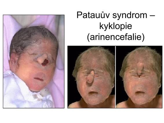 Patauův syndrom – kyklopie (arinencefalie) 
