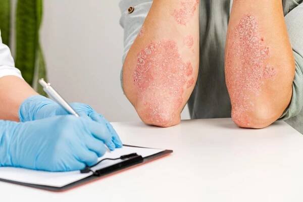 Bimekizumab v léčbě psoriázy