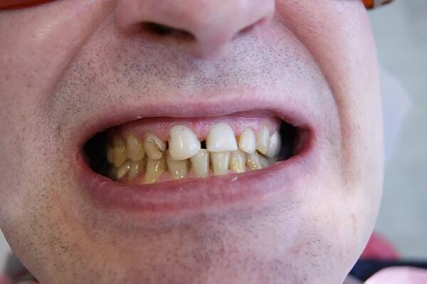 Cosmetic Dentistry - Dental Comfort