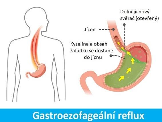 Reflux žaludeční kyseliny (kyselý reflux) – příznaky, příčiny a jak se léčí?