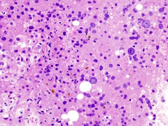 Hepatocelulární karcinom – WikiSkripta