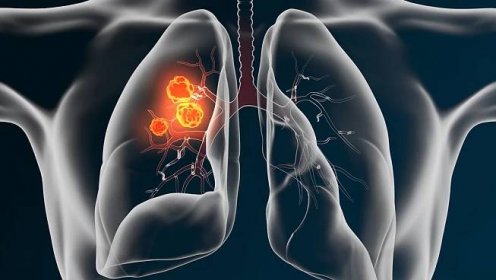 Rakovina plic číhá i na ty, co nekouří. Jak se chránit?