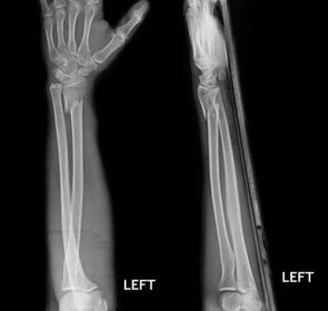 Zlomení hřídele poloměr & ulnární kosti, x-ray film — Stock obrázek
