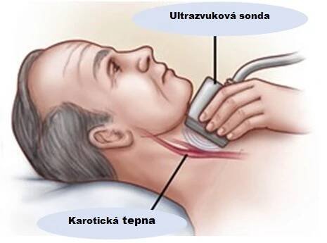 Onemocnění krčních tepen | Klinika AC medica