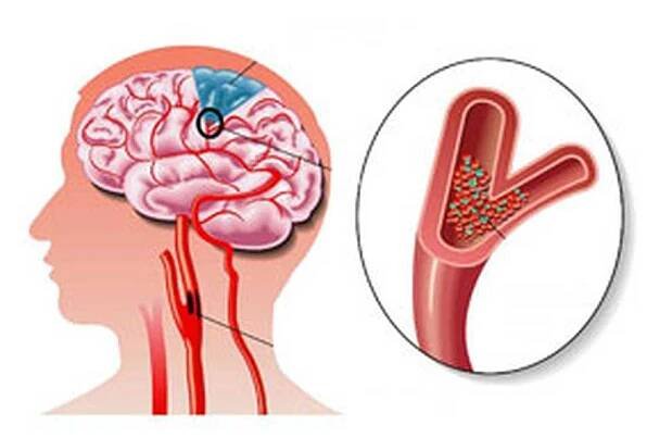 Cerebrální hypoxie / Hypoxie | Užitečné informace a tipy na péči o sebe. Zdraví, výživa a další.