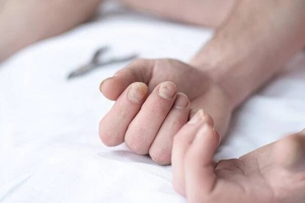Plíseň nehtů může postihnout nehty na rukou, je však častější u nehtů na nohou.
