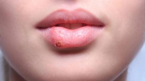 Nejčastější pohlavně přenosná choroba je herpes