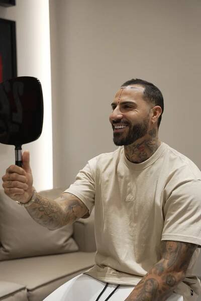Celebrity hair transplants - Cosmedica
