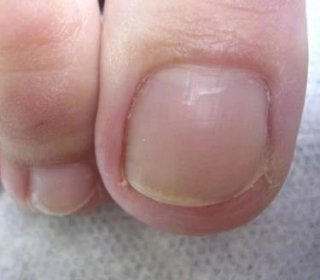 NOHY | Footlogix Anti-Fungal Toe Tincture - Sérum na plíseň nehtů u nohou (50 ml) | Bellapelle.cz | E-shop | Kosmetická