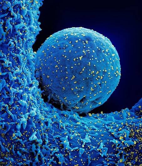 A colorized microscopic view of a round, blue cell, dotted with hundreds of small yellow dots, which are all COVID virus particles infecting the cell.