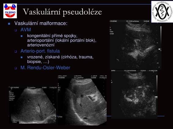 PPT - Benigní ložiskové léze jater PowerPoint Presentation, free download - ID:4188341
