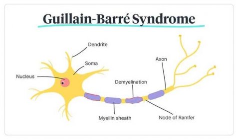 Guillain Barré syndrome diagram