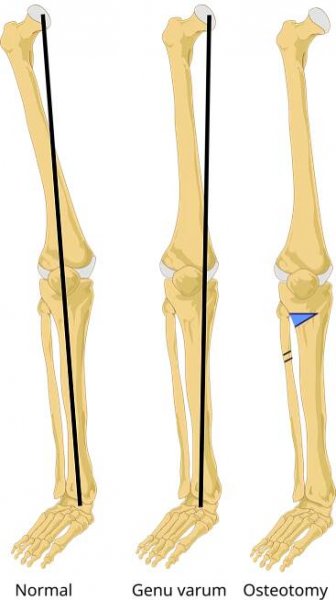 Soubor:Osteotomy tibia en.svg – Wikipedie