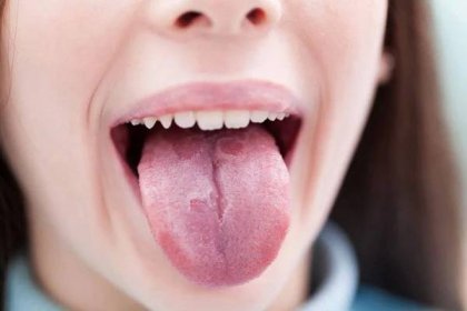 Sucho v ústech, xerostomie: co je to, Příčiny, příznaky, diagnostika, léčba, prevence