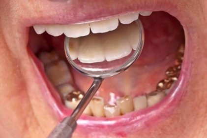vyšetření zubů - zlatý zub - stock snímky, obrázky a fotky