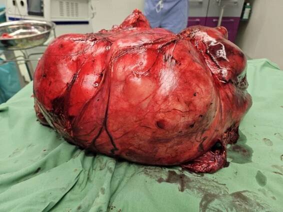 Medicínský zázrak. Seniorce odoperovali obří nádor, vážil 19 kilogramů