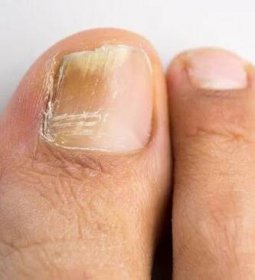Houba nehtu na palci u nohy, která se vyskytuje na pozadí slabé imunity