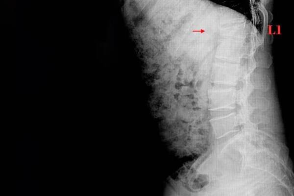 xray obraz bederních hřbetů ukazující kompresní zlomeninu bederní páteře l1. - lidské obratle - stock snímky, obrázky a fotky