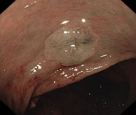 WASP classification – optical diagnosis of polyps – Endoscopy Campus