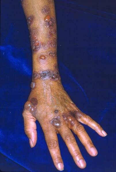 Bullous Pemphigoid - Skin Disorders - MSD Manual Consumer Version