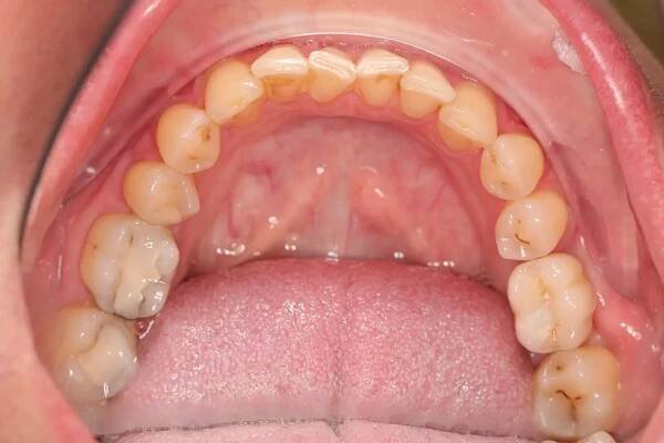 Zubní implantáty očima pacientů