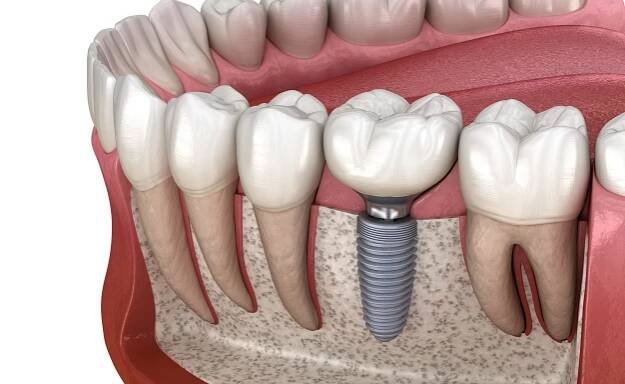 instalace molární korunky zubu nad opěrkou implantátu. lékařsky přesná 3d ilustrace lidského zubního a zubního protézy - zánět dásní - stock snímky, obrázky a fotky