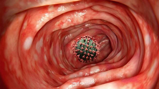 A computer rendering of a covid virus inside a colon affected by ulcerative colitis