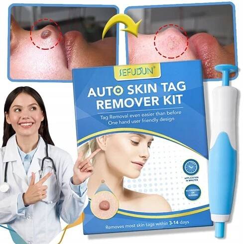 Odstranění Mole Stain Bradavice Odstraňovač Péče o obličej Pomůcky
